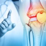 Understanding Arthritis: Navigating the Complex Landscape of Types, Symptoms, Causes, and Management